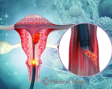 Cervical Cancer Treatment Cervical Cancer Treatment