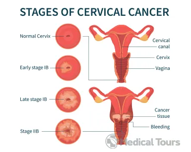 Stages of Cervical Cancer Stages of Cervical Cancer