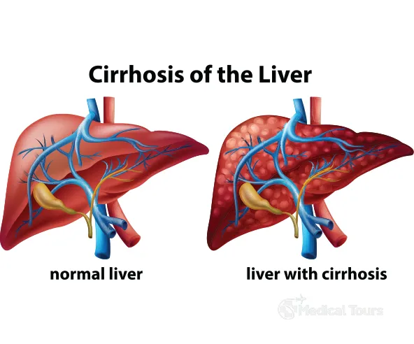 Cirrhosis of the Liver  Thumbay Hospital, Fujairah