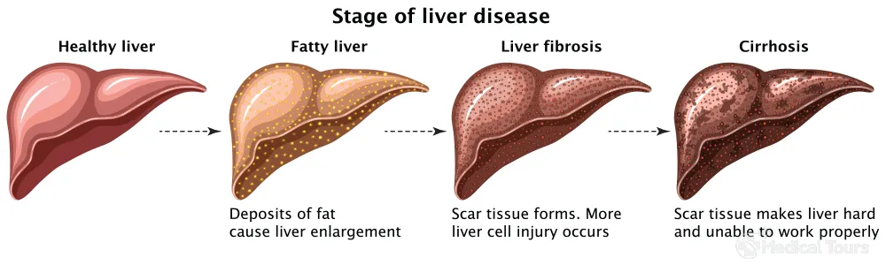 Liver Cirrhosis Best Doctors Cost and Hospitals in India