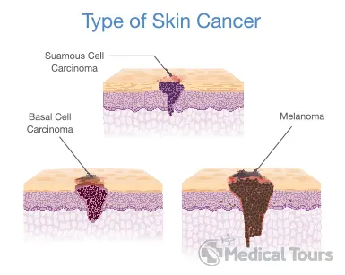 Skin Cancer Treatment | Best Skin Cancer Hospitals in India